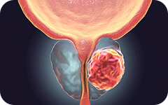 Cirugías para Cánceres Urológicos