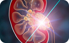 Cirugía Láser para Piedras Renales