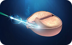 Cirugía Láser de Próstata