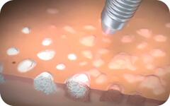 Remoción Láser de Verrugas de VPH