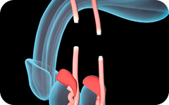 Vasectomía sin Bisturí